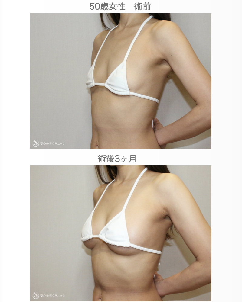 【50歳女性・柔らかく自然で綺麗なバスト】プレミアムセリューション豊胸術（3ヶ月後） After 