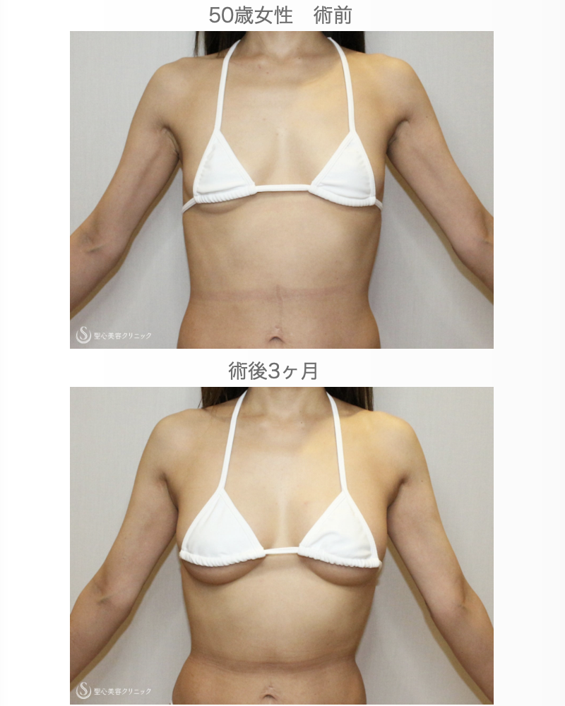 【50歳女性・柔らかく自然で綺麗なバスト】プレミアムセリューション豊胸術（3ヶ月後） After 