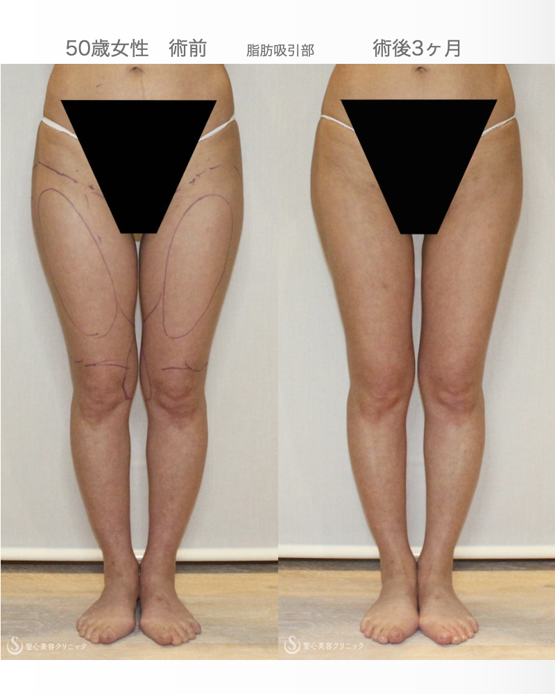 【50歳女性・柔らかく自然で綺麗なバスト】プレミアムセリューション豊胸術（3ヶ月後） After 