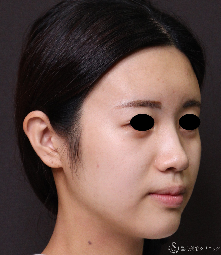 【20代女性・フェイスラインをシャープに】脂肪吸引注射（頬・あご下）（5ヶ月後） Before 