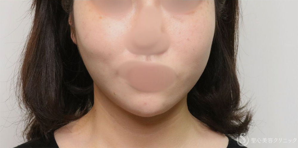 【20代女性・フェイスラインがすっきり】脂肪吸引（頬・顎下）（1ヶ月後） After 名古屋+小顔・脂肪吸引