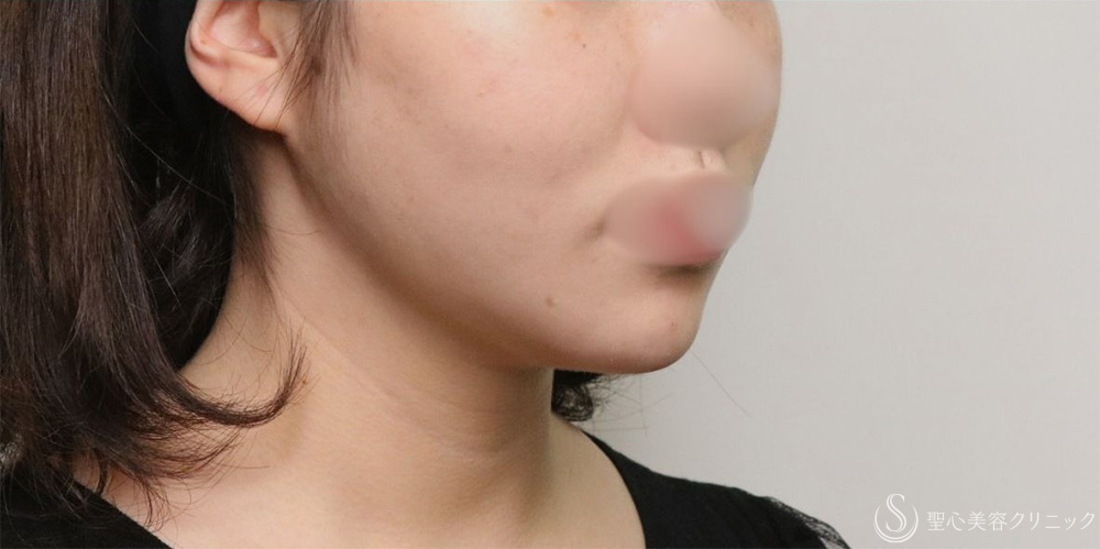 【20代女性・フェイスラインがすっきり】脂肪吸引（頬・顎下）（1ヶ月後） After 名古屋+小顔・脂肪吸引