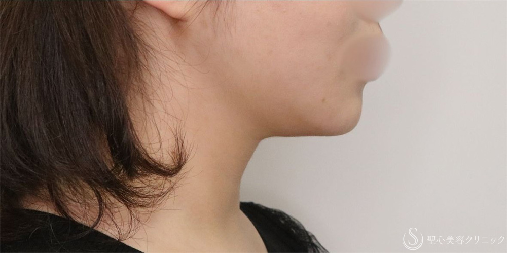 【20代女性・フェイスラインがすっきり】脂肪吸引（頬・顎下）（1ヶ月後） After 名古屋+小顔・脂肪吸引