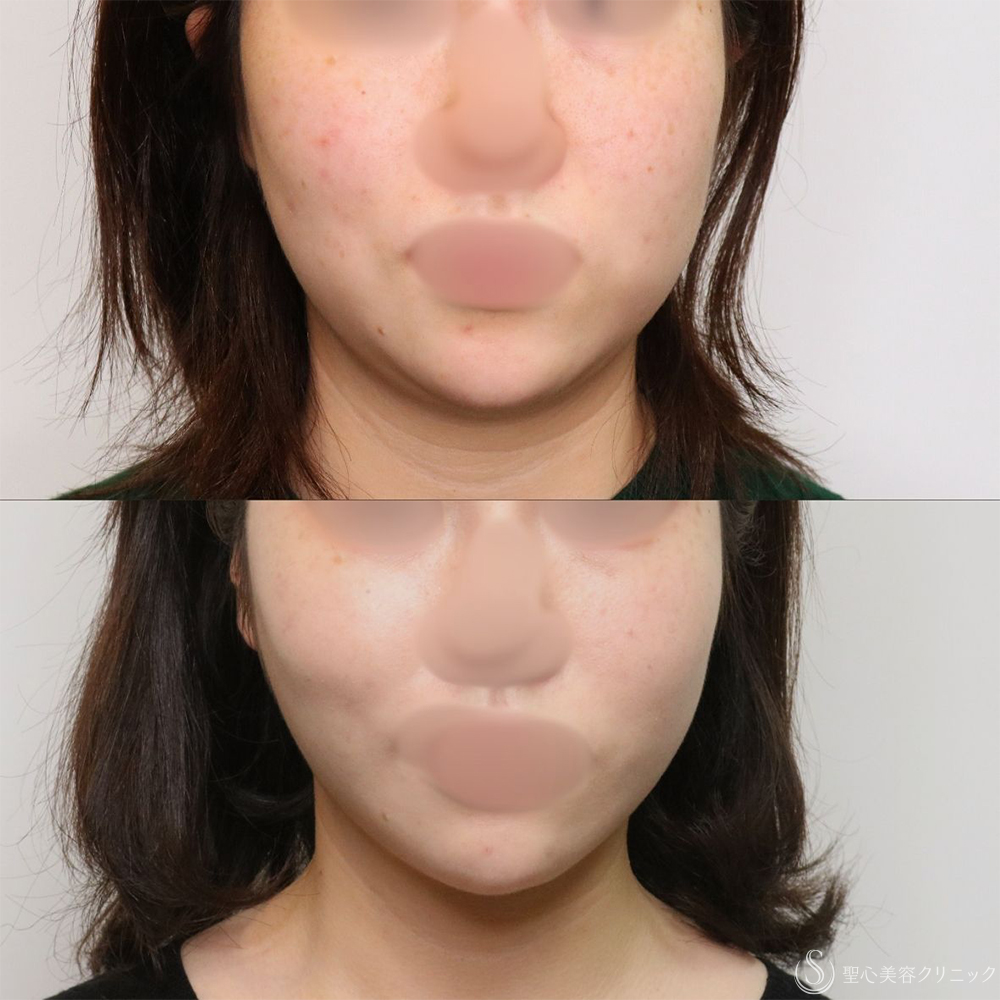 【20代女性・フェイスラインがすっきり】脂肪吸引（頬・顎下）（1ヶ月後） After 名古屋+小顔・脂肪吸引