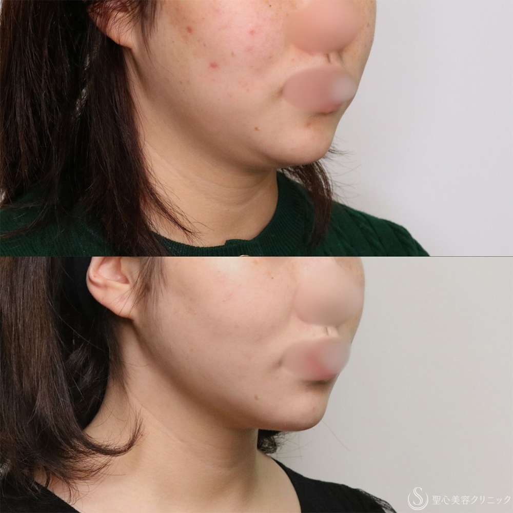 【20代女性・フェイスラインがすっきり】脂肪吸引（頬・顎下）（1ヶ月後） After 名古屋+小顔・脂肪吸引