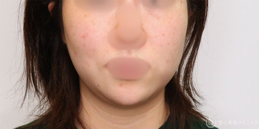 【20代女性・フェイスラインがすっきり】脂肪吸引（頬・顎下）（1ヶ月後） Before 名古屋+小顔・脂肪吸引