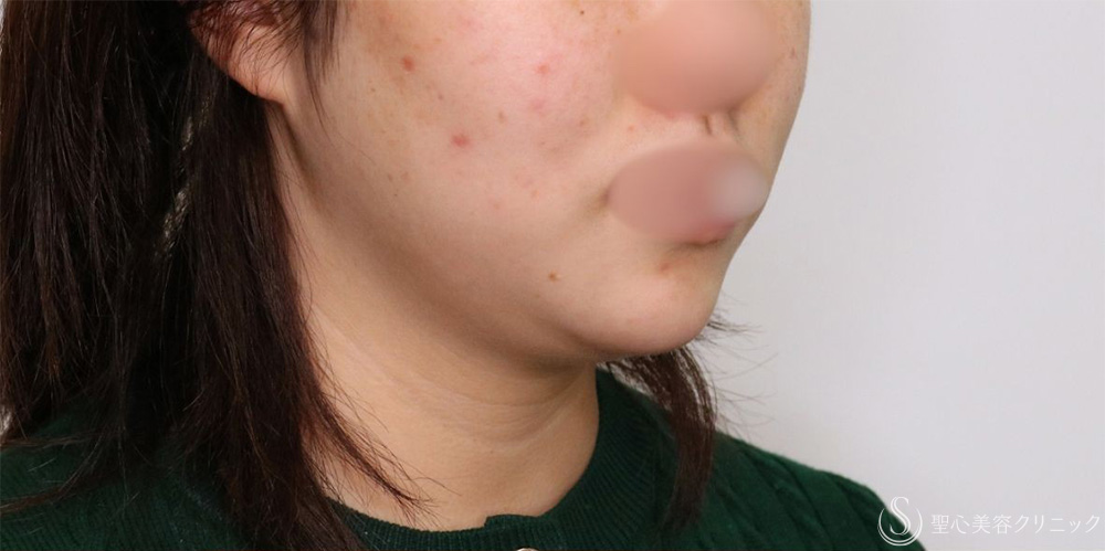 【20代女性・フェイスラインがすっきり】脂肪吸引（頬・顎下）（1ヶ月後） Before 名古屋+小顔・脂肪吸引