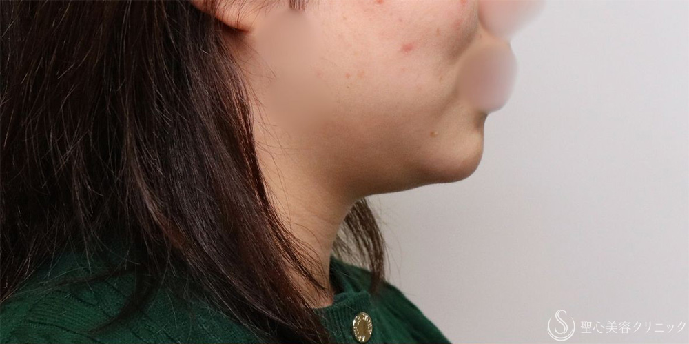 【20代女性・フェイスラインがすっきり】脂肪吸引（頬・顎下）（1ヶ月後） Before 名古屋+小顔・脂肪吸引