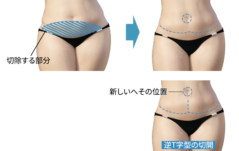 下腹部皮膚切除＋上下腹部剥離