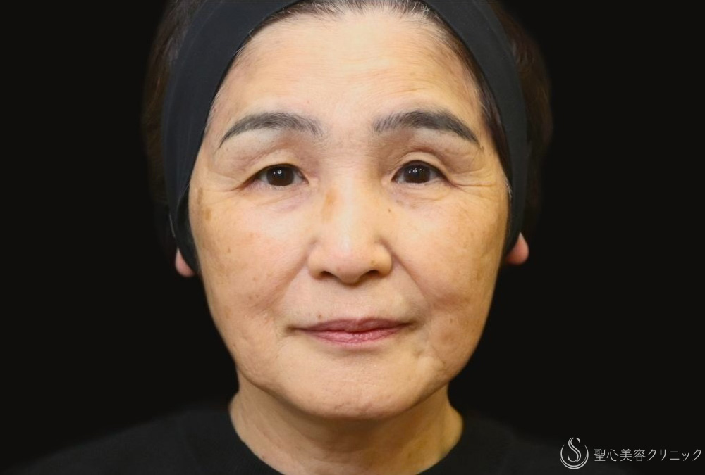 【70代女性・プレミアムPRPで自然な若返り】プレミアムPRP皮膚再生療法（1年後） After 