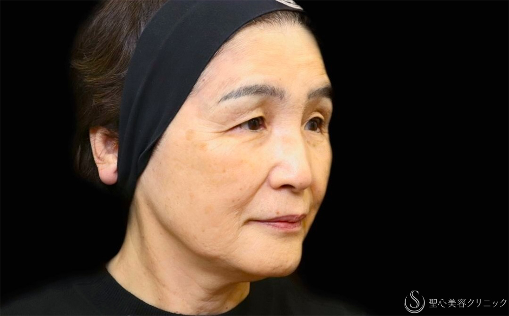 【70代女性・プレミアムPRPで自然な若返り】プレミアムPRP皮膚再生療法（1年後） After 
