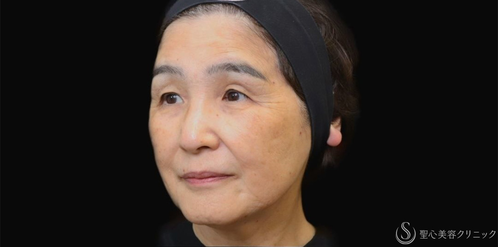 【70代女性・プレミアムPRPで自然な若返り】プレミアムPRP皮膚再生療法（1年後） After 