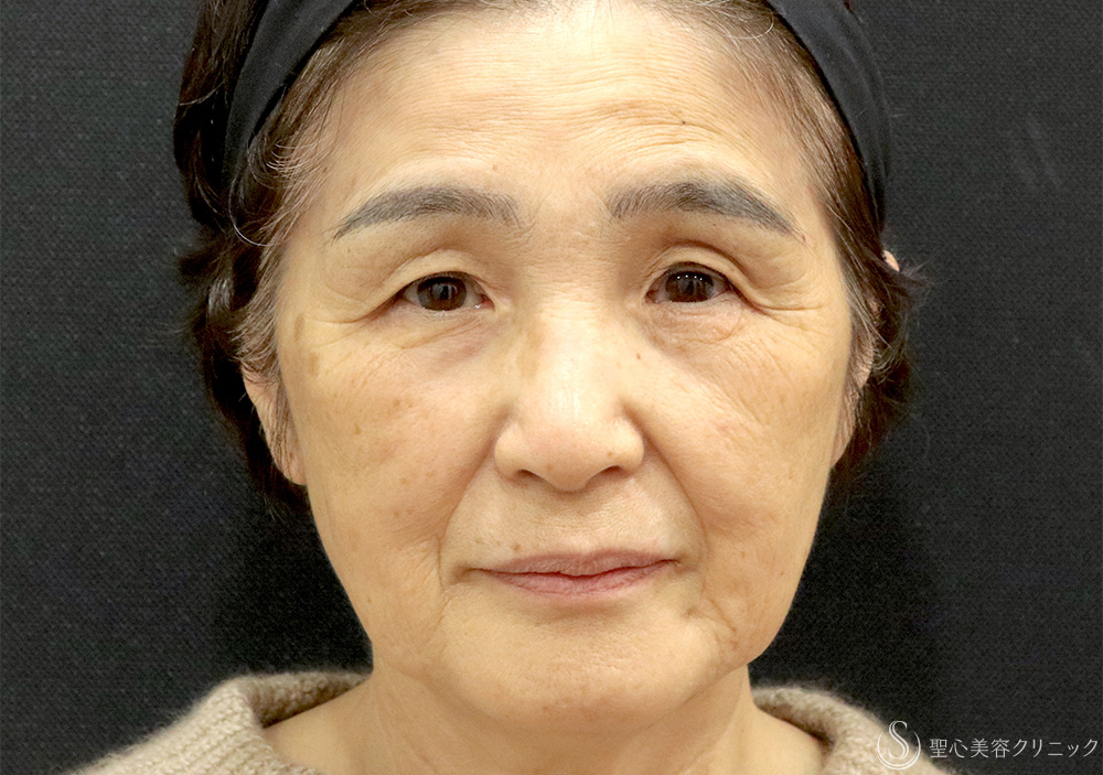 【70代女性・プレミアムPRPで自然な若返り】プレミアムPRP皮膚再生療法（1年後） Before 