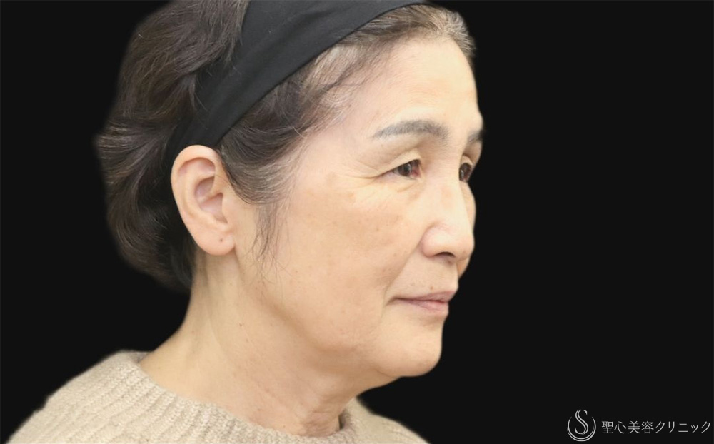 【70代女性・プレミアムPRPで自然な若返り】プレミアムPRP皮膚再生療法（1年後） Before 