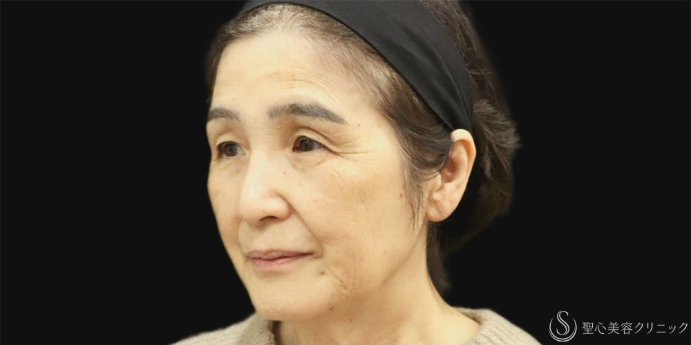 【70代女性・プレミアムPRPで自然な若返り】プレミアムPRP皮膚再生療法（1年後） Before 