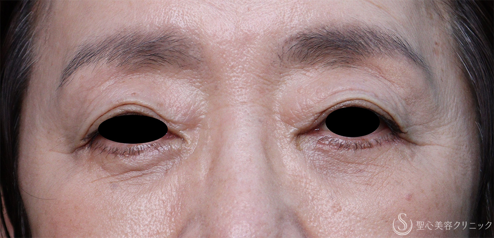 【60代女性・目の下のたるみ】下眼瞼除皺術（脂肪除去あり）（1ヶ月後） After 
