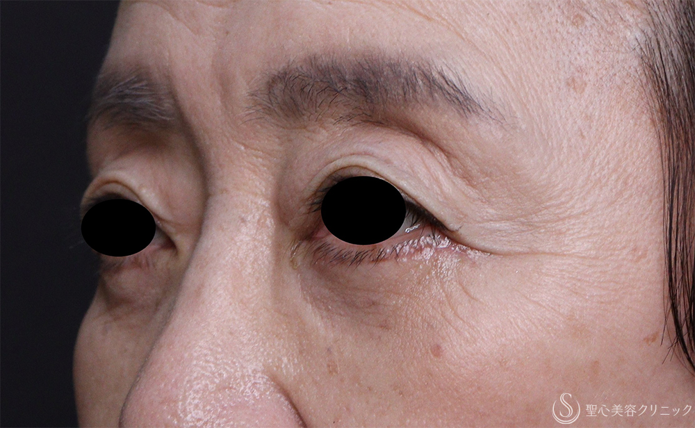 【60代女性・目の下のたるみ】下眼瞼除皺術（脂肪除去あり）（1ヶ月後） After 