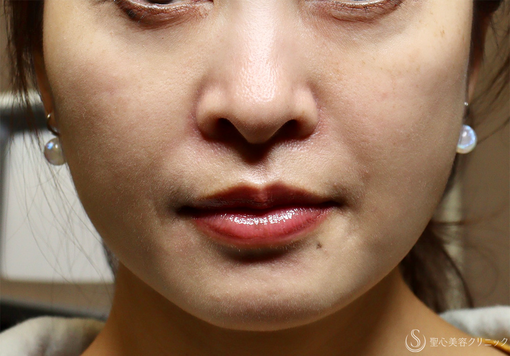 【40代女性・肌育で若返り】プレミアムPRP皮膚再生療法（3年後） After 