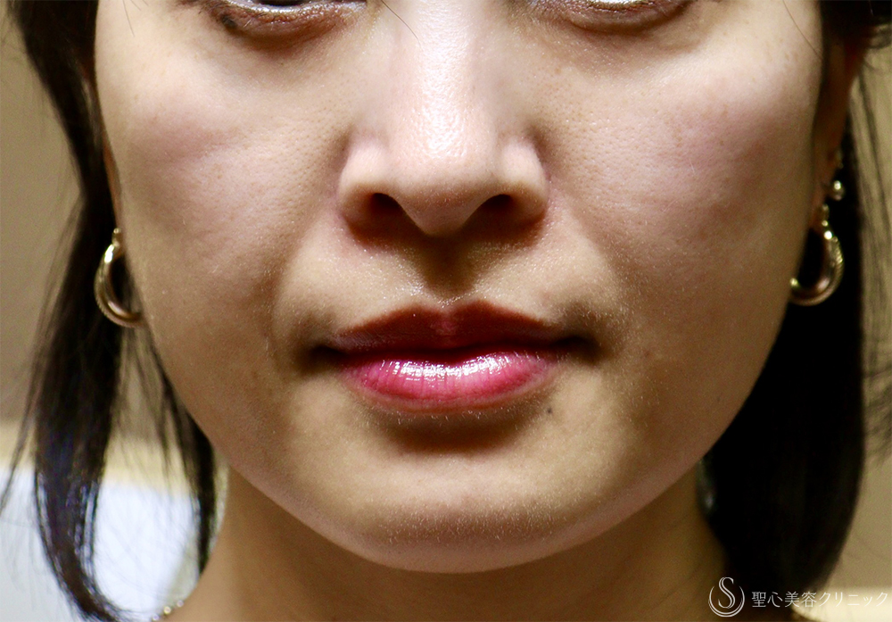 【40代女性・肌育で若返り】プレミアムPRP皮膚再生療法（3年後） Before 
