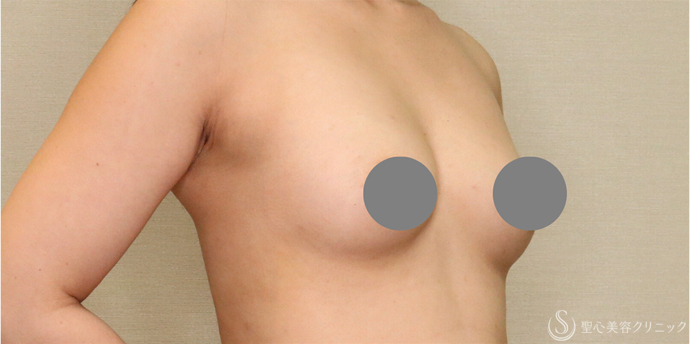 【40代女性・自然な質感でボリュームアップ】セリューション豊胸術（1ヶ月後） Before 名古屋+脂肪吸引・豊胸・脂肪豊胸・バストアップ