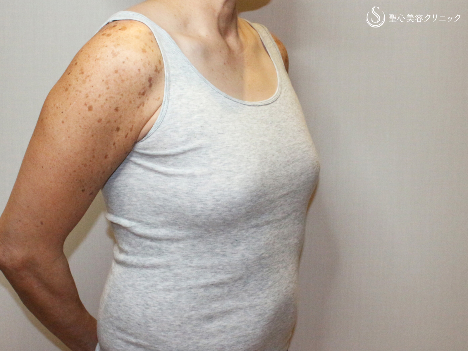 【50歳FTM・「性同一性障害」男らしい胸に】乳腺切除＋脂肪吸引（術直後〜3ヶ月後） Before 