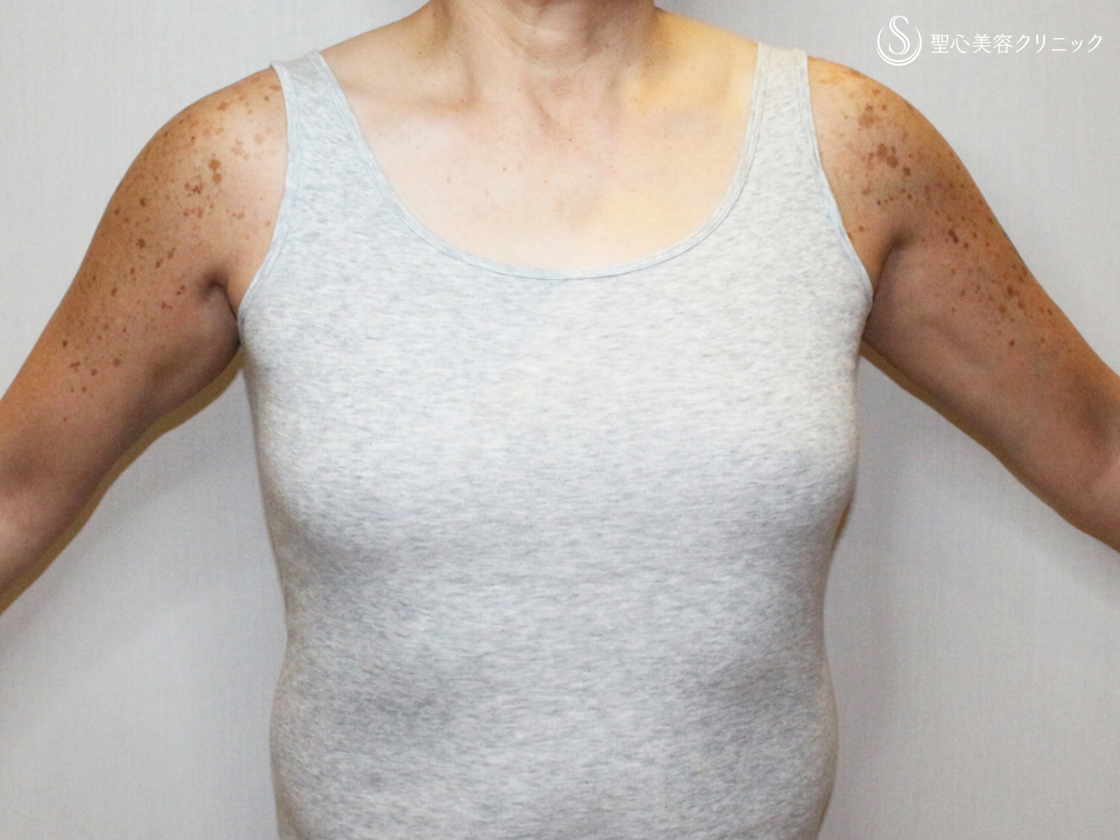 【50歳FTM・「性同一性障害」男らしい胸に】乳腺切除＋脂肪吸引（術直後〜3ヶ月後） Before 