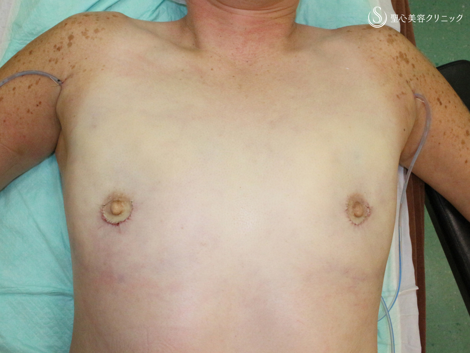 【50歳FTM・「性同一性障害」男らしい胸に】乳腺切除＋脂肪吸引（術直後〜3ヶ月後） Before 