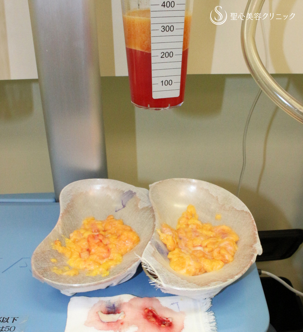 【50歳FTM・「性同一性障害」男らしい胸に】乳腺切除＋脂肪吸引（術直後〜3ヶ月後） Before 