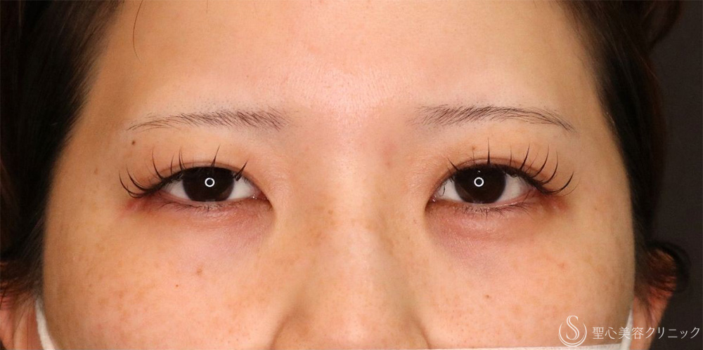 【20代女性・ぱっちり二重に】マイクロメソッド＋α法（1週間後・1ヶ月後） Before 名古屋+二重　平行二重　ミックス二重