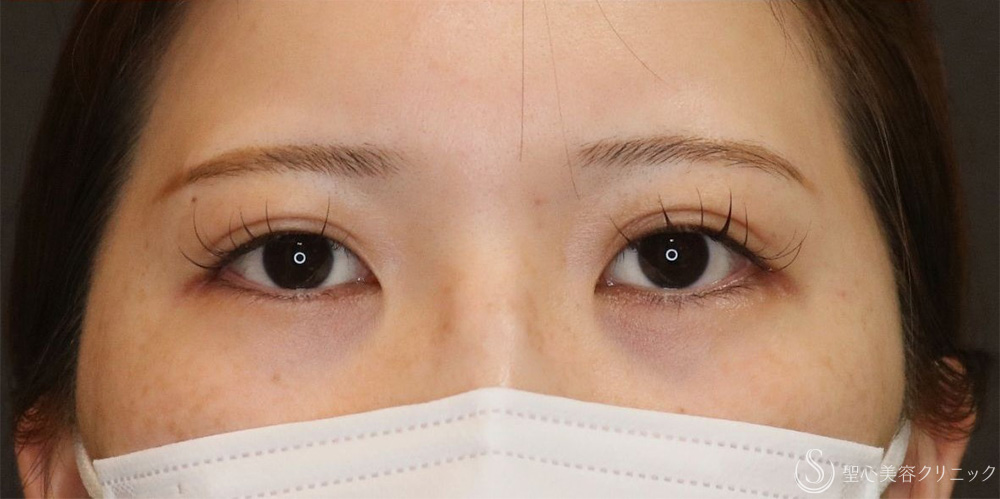 【20代女性・ぱっちり二重に】マイクロメソッド＋α法（1週間後・1ヶ月後） After 名古屋+二重　平行二重　ミックス二重