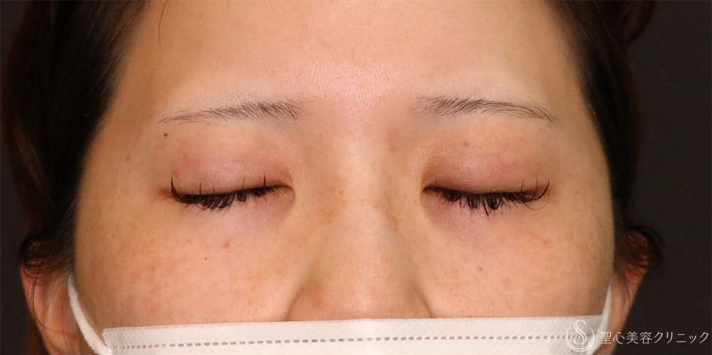【20代女性・ぱっちり二重に】マイクロメソッド＋α法（1週間後・1ヶ月後） Before 名古屋+二重　平行二重　ミックス二重