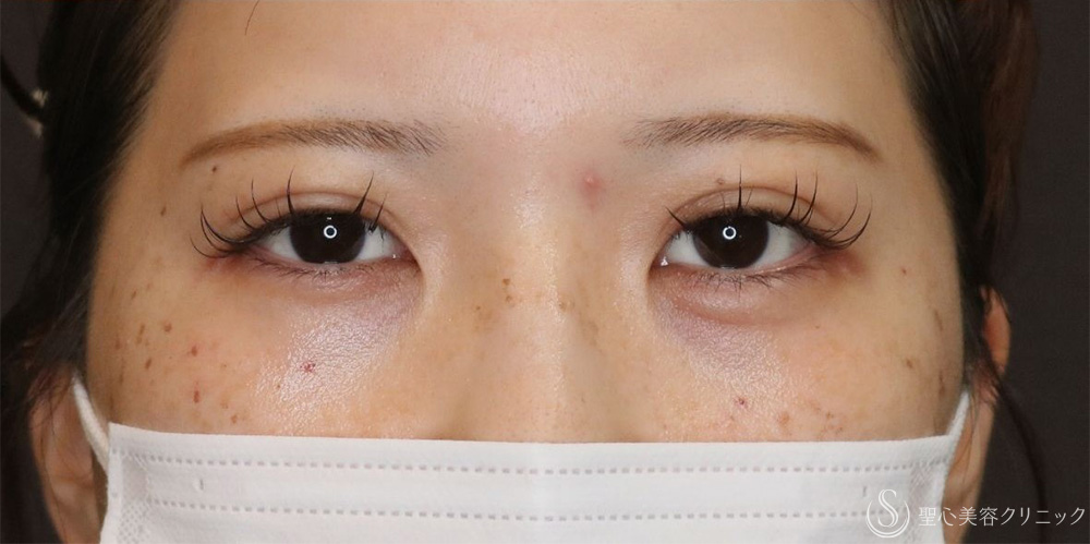 【20代女性・ぱっちり二重に】マイクロメソッド＋α法（1週間後・1ヶ月後） After 名古屋+二重　平行二重　ミックス二重