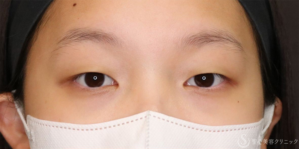 【10代女性・自然な奥二重に】マイクロメソッド＋α法（1ヶ月後） Before 名古屋+二重　平行二重　ぱっちり二重