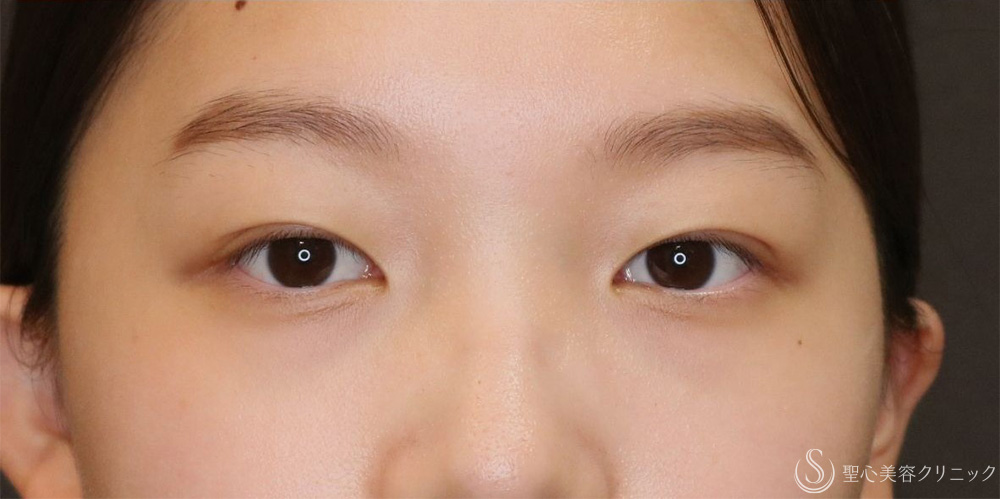 【10代女性・自然な奥二重に】マイクロメソッド＋α法（1ヶ月後） After 名古屋+二重　平行二重　ぱっちり二重