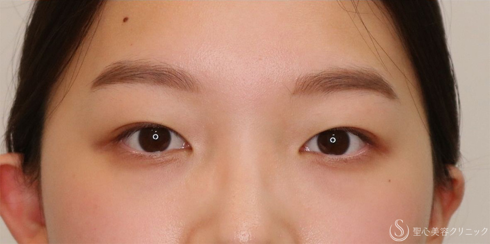 【10代女性・自然な奥二重に】マイクロメソッド＋α法（1ヶ月後） After 名古屋+二重　平行二重　ぱっちり二重
