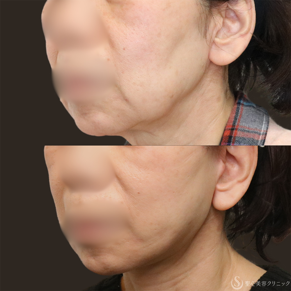 【60代女性・長期的なリフトアップ】フェイスリフト＋脂肪吸引（頬＋顎下）＋リガメント処理（1ヶ月後） After 名古屋+フェイスリフト　たるみ　脂肪吸引