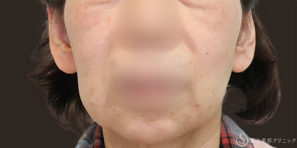 【60代女性・長期的なリフトアップ】フェイスリフト＋脂肪吸引（頬＋顎下）＋リガメント処理（1ヶ月後） Before 名古屋+フェイスリフト　たるみ　脂肪吸引