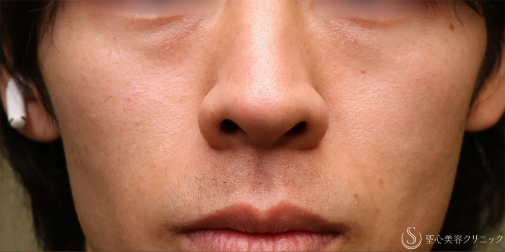 【30代男性・自然な若返り】プレミアムPRP皮膚再生療法（目の下）（1年後） Before 名古屋+目の下のくま　目の下の脂肪取り