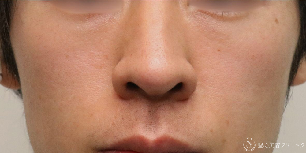 【30代男性・自然な若返り】プレミアムPRP皮膚再生療法（目の下）（1年後） After 名古屋+目の下のくま　目の下の脂肪取り
