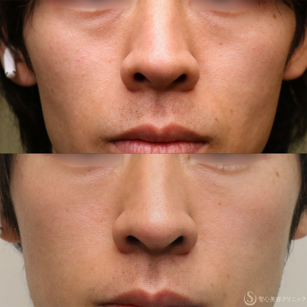 【30代男性・自然な若返り】プレミアムPRP皮膚再生療法（目の下）（1年後） After 名古屋+目の下のくま　目の下の脂肪取り