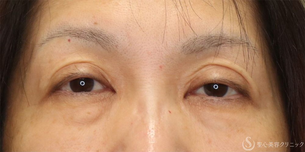 【50代女性・切らずに目の開き改善】眼瞼下垂埋没法（1ヶ月後） Before 名古屋+眼瞼下垂　埋没法