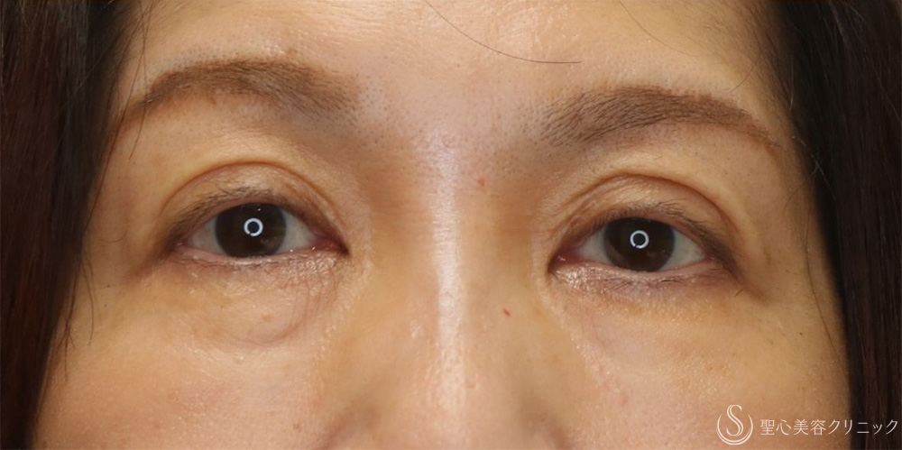 【50代女性・切らずに目の開き改善】眼瞼下垂埋没法（1ヶ月後） After 名古屋+眼瞼下垂　埋没法
