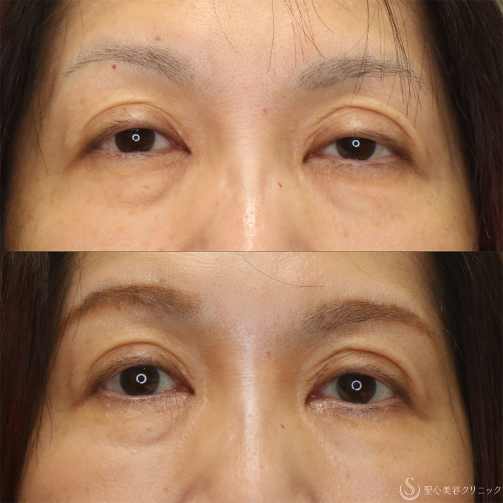 【50代女性・切らずに目の開き改善】眼瞼下垂埋没法（1ヶ月後） After 名古屋+眼瞼下垂　埋没法