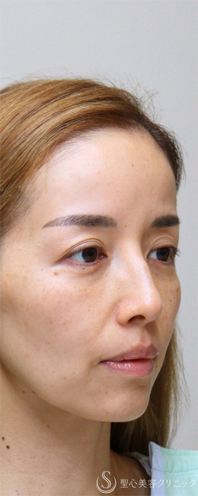 【40代女性・目元の疲れ感をリセット】裏ハムラ（右）＋眉下切開（術後3ヶ月） Before 