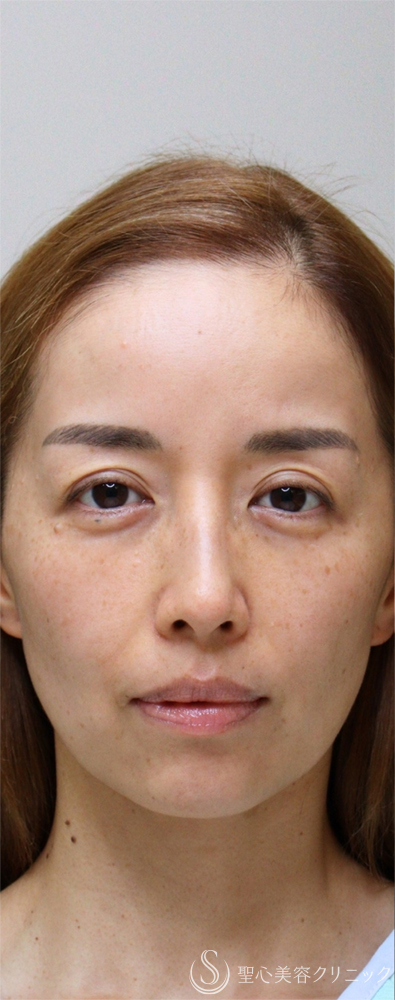【40代女性・目元の疲れ感をリセット】裏ハムラ（右）＋眉下切開（術後3ヶ月） Before 