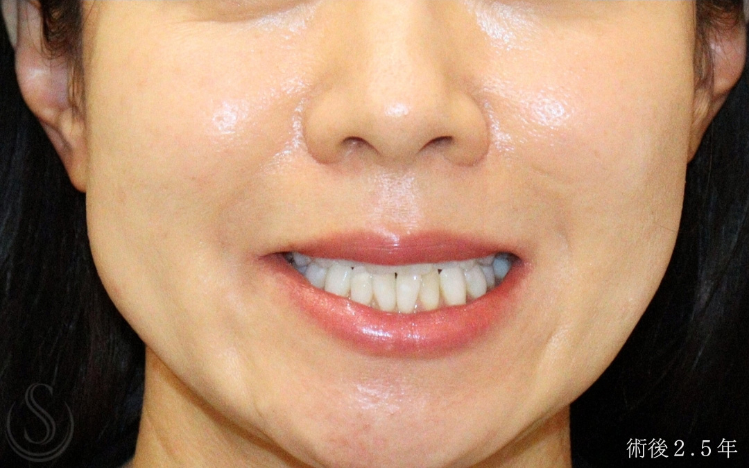 【50代女性・笑顔時の小鼻の広がりを改善】小鼻縮小術＋側頭筋膜移植（2年6ヶ月後） After 