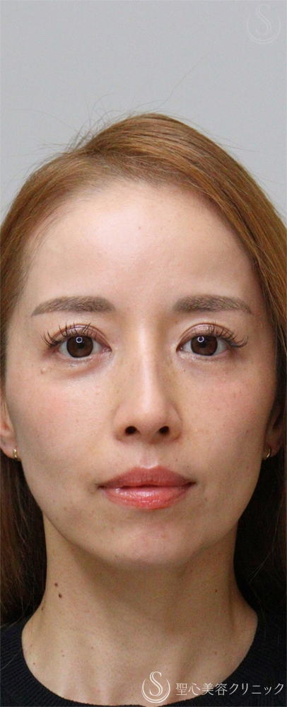 【40代女性・目元の疲れ感をリセット】裏ハムラ（右）＋眉下切開（術後3ヶ月） After 