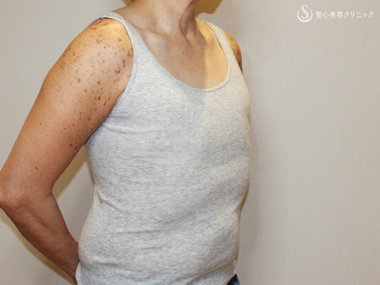 【50歳FTM・「性同一性障害」男らしい胸に】乳腺切除＋脂肪吸引（術直後〜3ヶ月後） After 