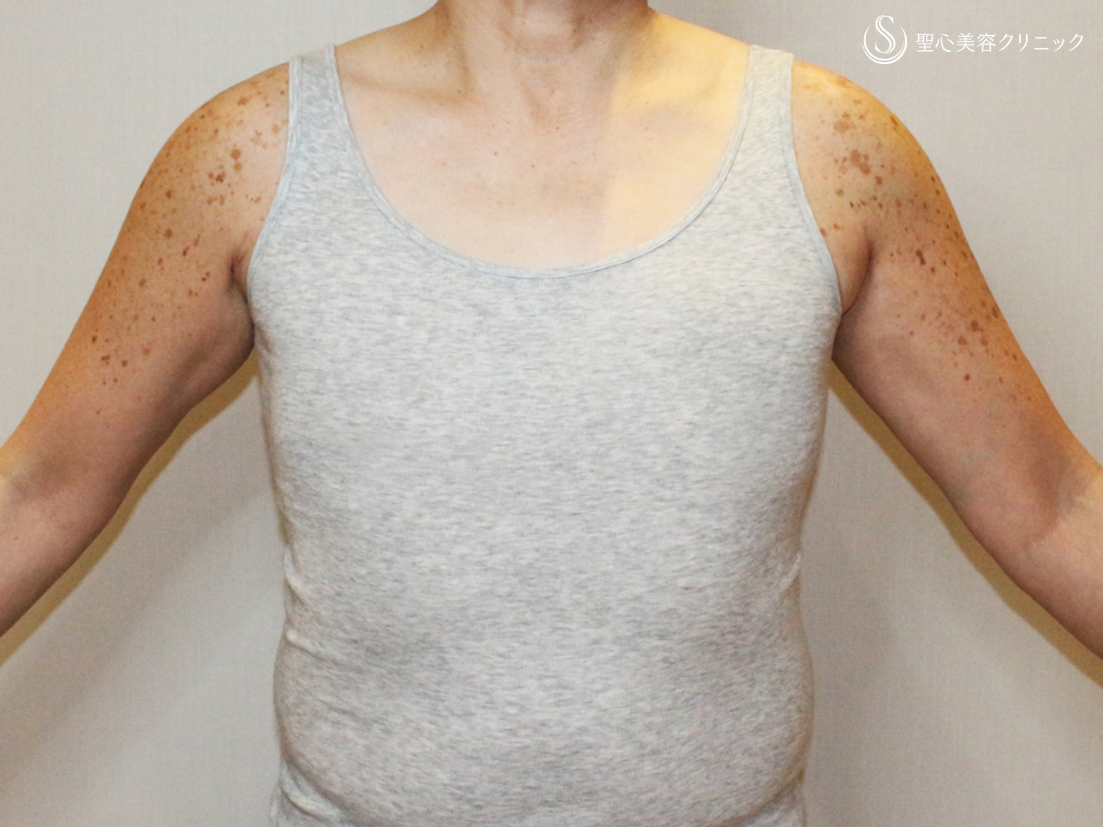 【50歳FTM・「性同一性障害」男らしい胸に】乳腺切除＋脂肪吸引（術直後〜3ヶ月後） After 