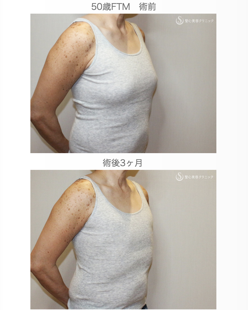 【50歳FTM・「性同一性障害」男らしい胸に】乳腺切除＋脂肪吸引（術直後〜3ヶ月後） After 